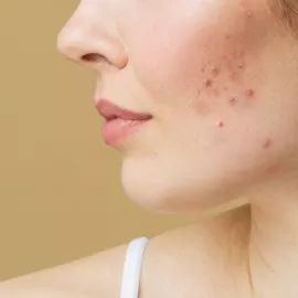Acne