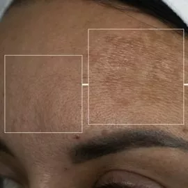 Depigmentation