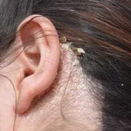 Seborrheic Dermatitis